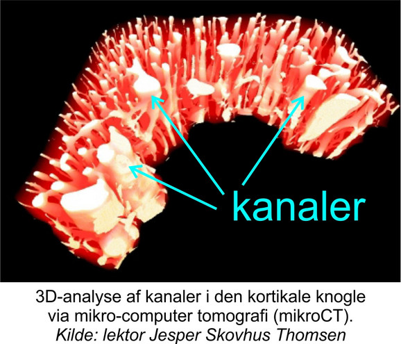 3D-analyse af kanaler i den kortikale knogle via mikro-computer tomografi (mikroCT). Kilde: lektor Jesper Skovhus Thomsen